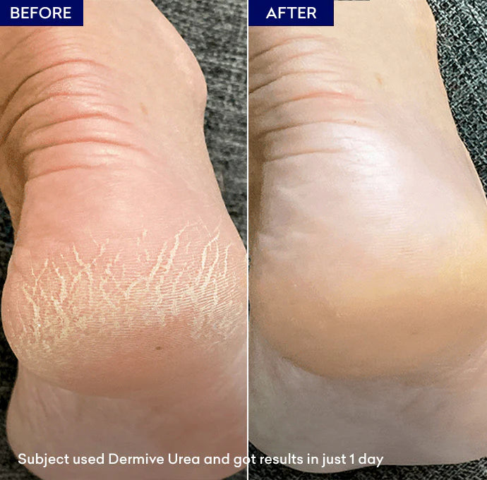 Dermive Urea Moisturizer