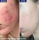 Clarevo Anti Acne Soap