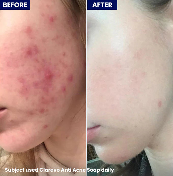 Clarevo Anti Acne Soap