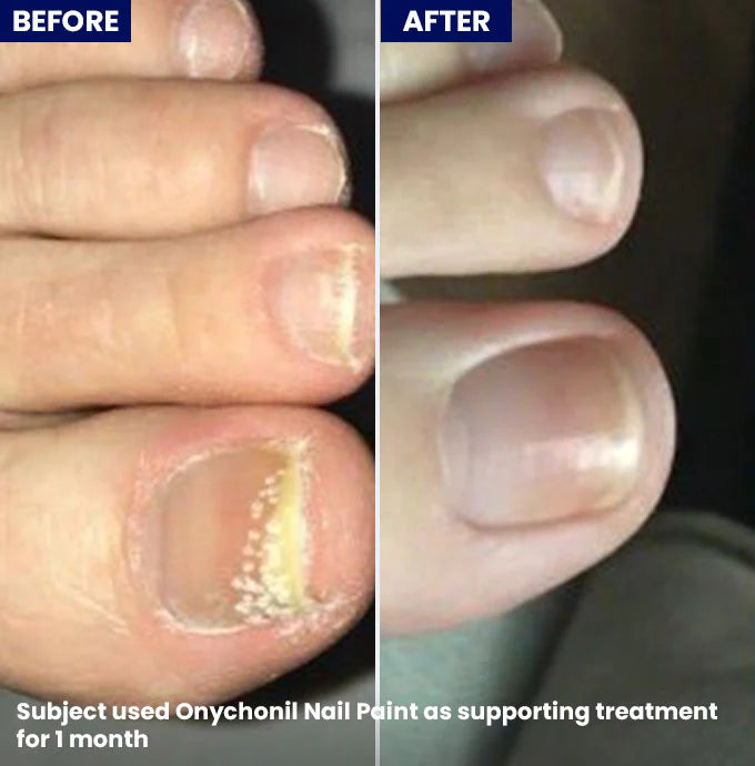 Onychonil Nail Paint