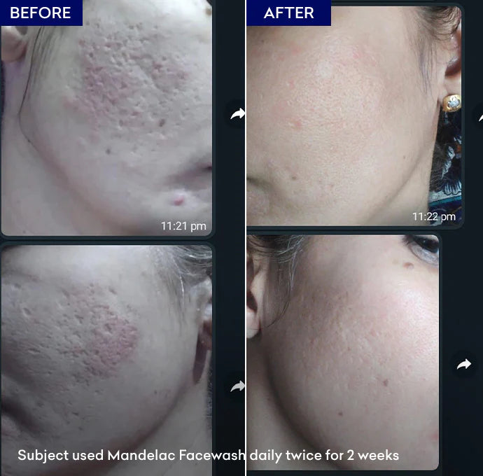 MandelAC Facewash